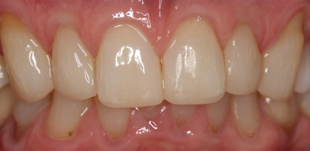 what-is-tooth-wear-after-1