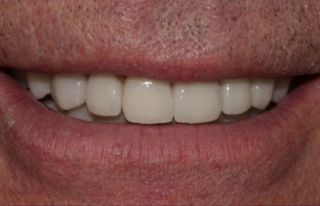 what-is-tooth-wear-after-2