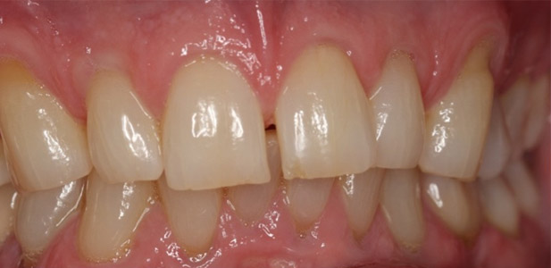 what-is-tooth-wear-before-1