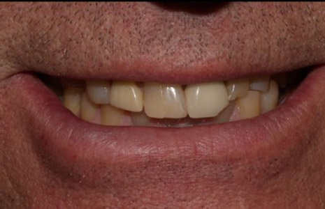 what-is-tooth-wear-before-2